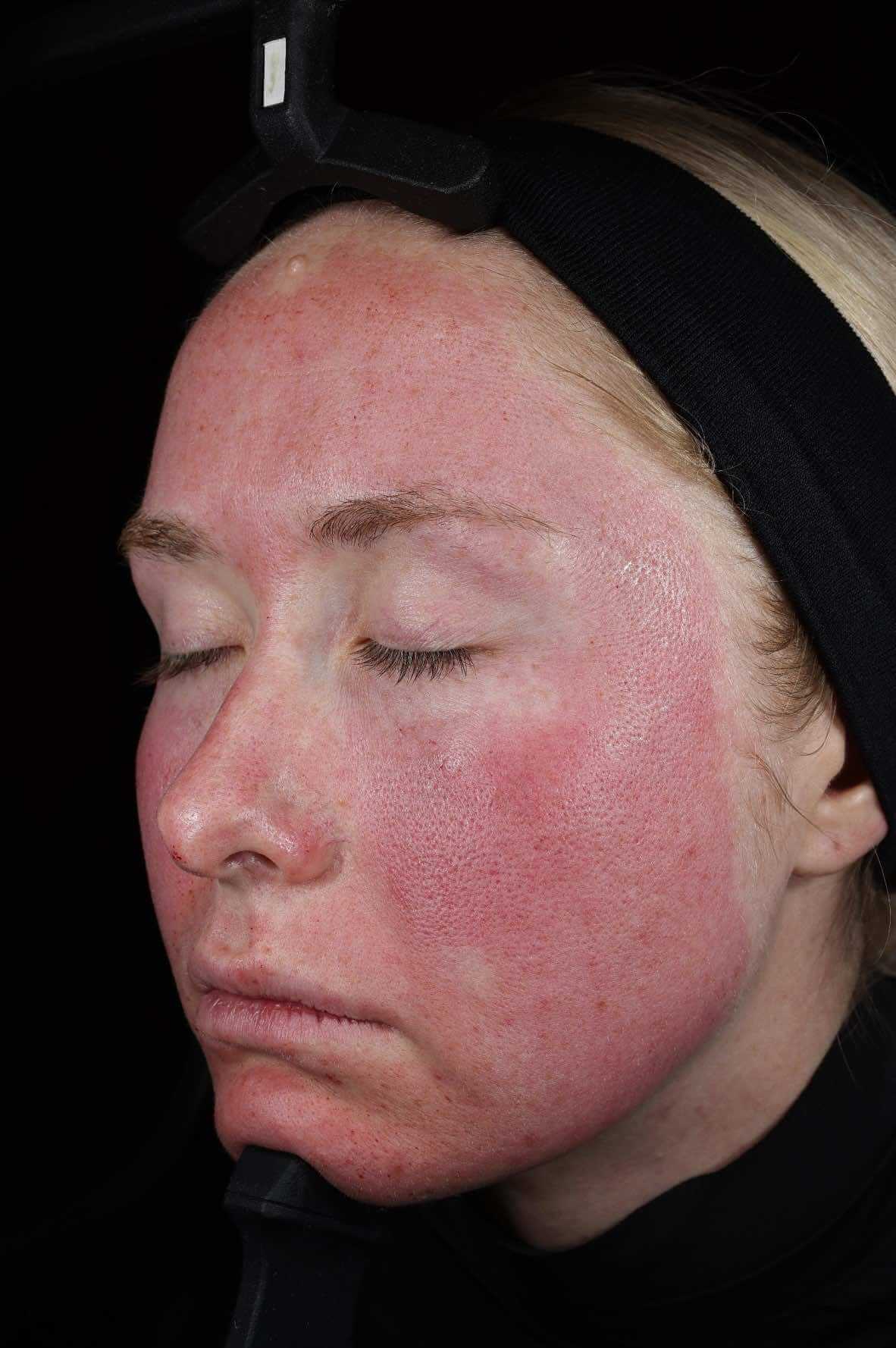 SkinPen treatment progress 1 Hour