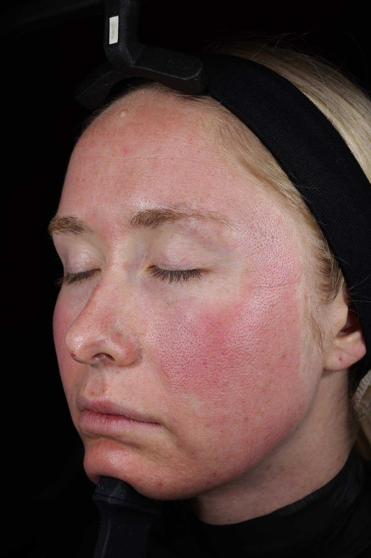 SkinPen treatment progress 4 Hours